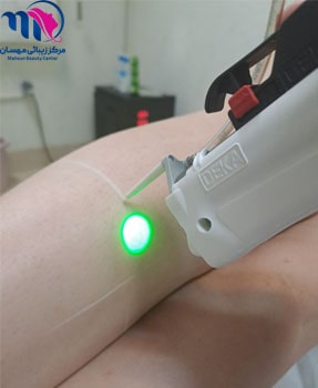 لیزر موهای زائد پاها